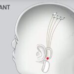 neuralink brain implant technology Neuralink claims first successful human brain implant