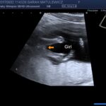 fast exam 14 week ultrasound Ultrasound 14 week