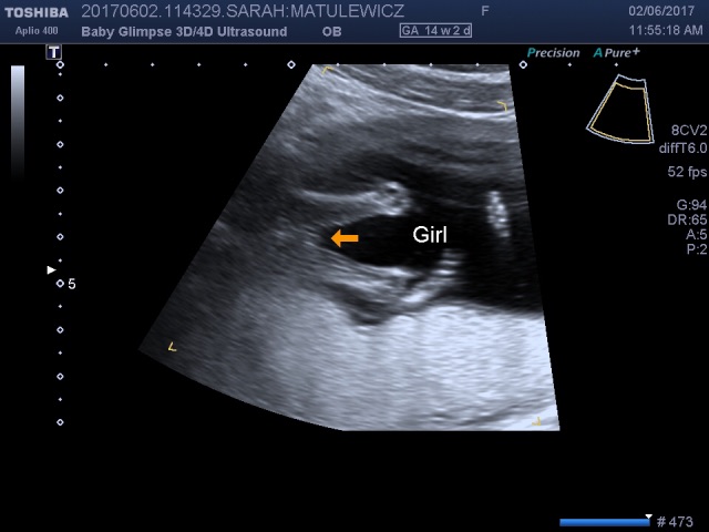 fast exam 14 week ultrasound Ultrasound 14 week