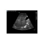 fast exam liver diaphragm Fast exam ultrasound training model